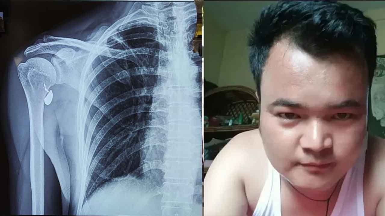 Firing in Park Circus: বাজুবন্ধনীর কাছে হাড়ে বিঁধে বুলেট, পার্ক সার্কাস গুলি কাণ্ডে আহত বসির এখনও মৃত্যুর সঙ্গে লড়ছেন Firing in Park Circus: বাজুবন্ধনীর কাছে হাড়ে বিঁধে বুলেট, পার্ক সার্কাস গুলি কাণ্ডে আহত বসির এখনও মৃত্যুর সঙ্গে লড়ছেন