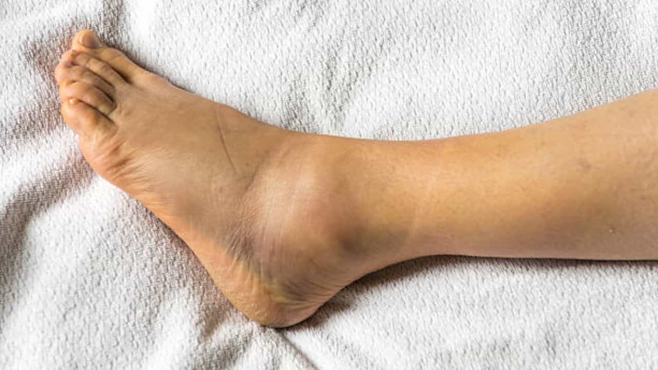 Swollen Legs: হঠাৎ করেই পা ফুলছে! শরীরের কোন জটিল রোগের বিপদ সংকেত?