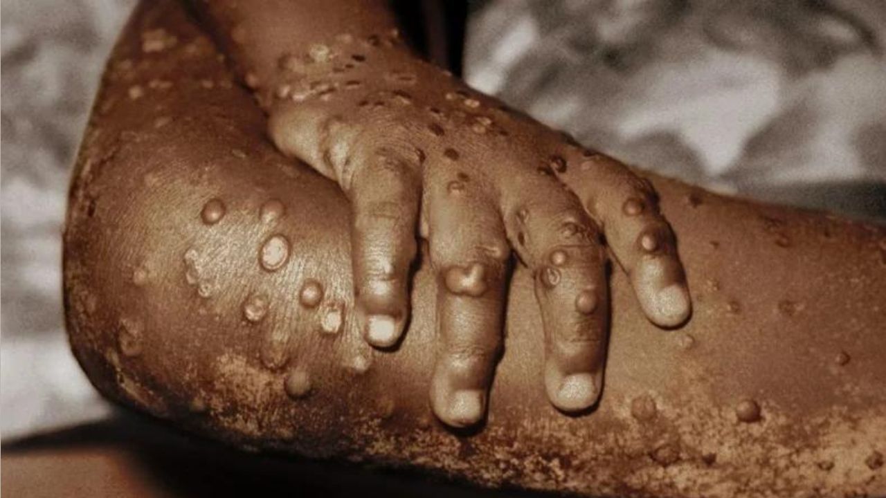 Monkeypox in India: কেরলের পর এবার দিল্লি, খোঁজ মিলল চতুর্থ মাঙ্কিপক্সে আক্রান্তের