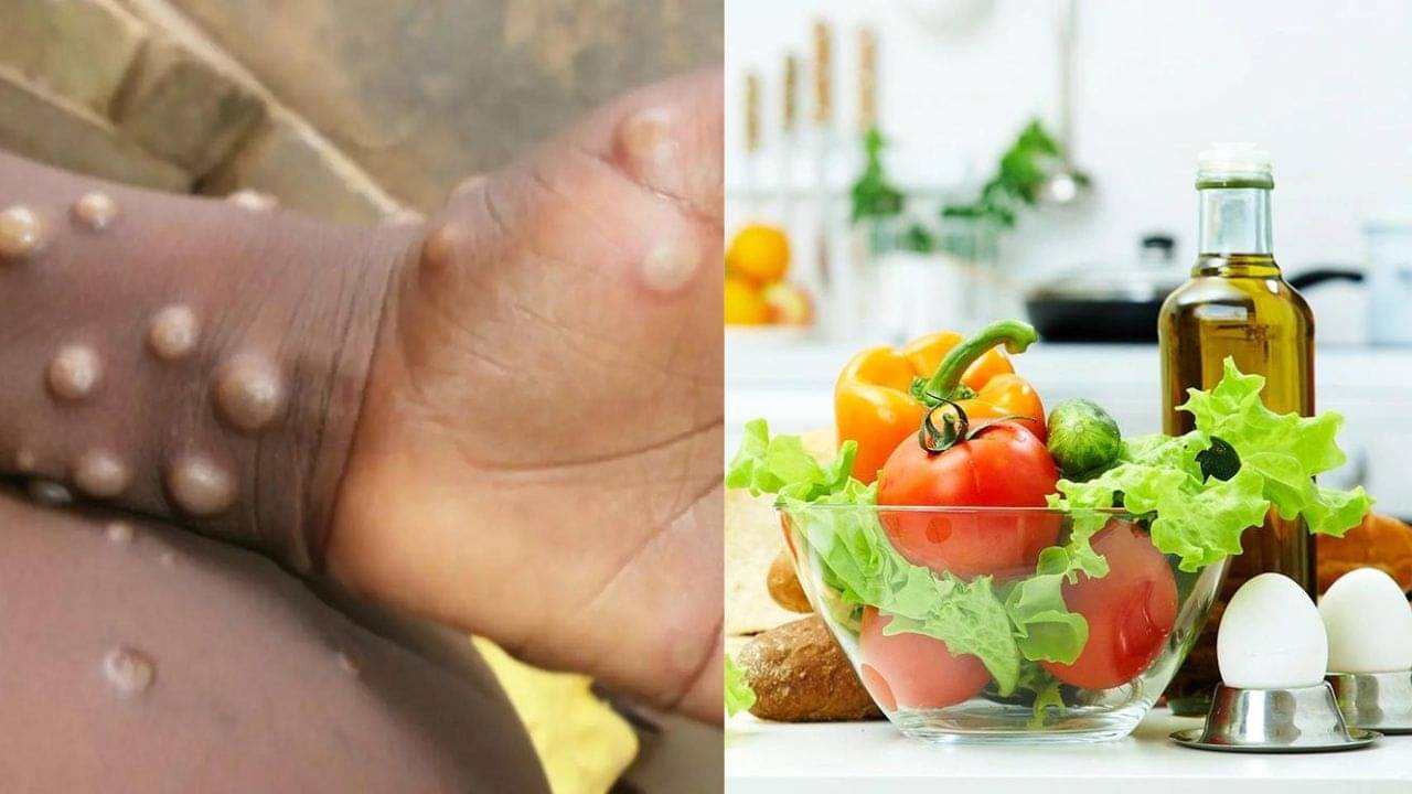 Monkeypox in India: মাঙ্কিপক্স হলে দ্রুত সেরে উঠতে কোন ধরনের খাবার খাবেন? বিশেষজ্ঞ পরামর্শ জানুন