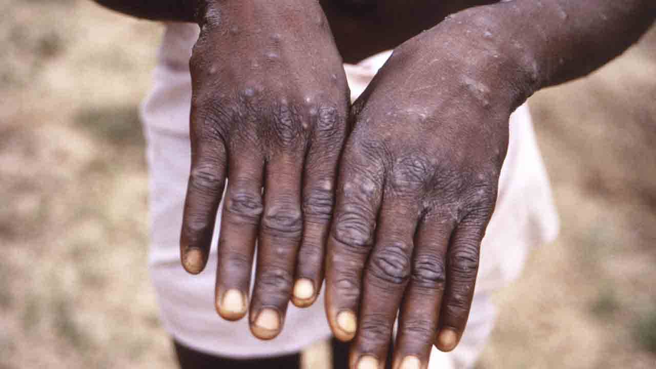 Monkeypox in India: রোগীর সংস্পর্শে এলেই বিপদ, মাঙ্কিপক্স নিয়ে রাজ্যগুলিকে সতর্ক করল কেন্দ্র