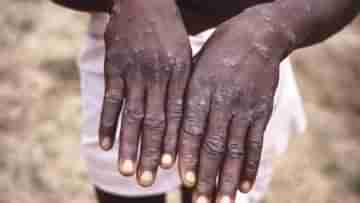 Monkeypox in India: রোগীর সংস্পর্শে এলেই বিপদ, মাঙ্কিপক্স নিয়ে রাজ্যগুলিকে সতর্ক করল কেন্দ্র