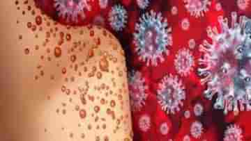 New Symptoms of Monkeypox: ভারতে থাবা বসিয়েছে মাঙ্কিপক্স! নয়া ৩ উপসর্গে উদ্বেগ বাড়াচ্ছে বিশেষজ্ঞদের