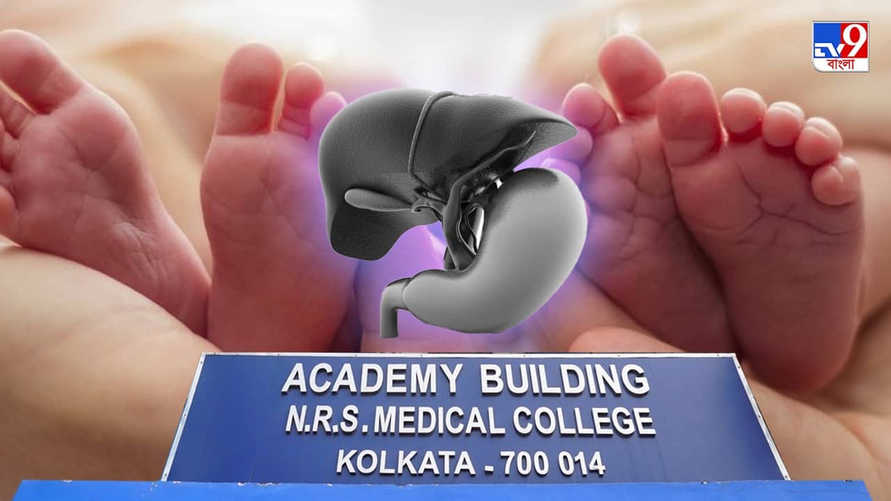Conjoined Twins in West Bengal: দুই সদ্যজাতর শরীরে লিভার একটাই, বিরল অস্ত্রোপচারের নজির কলকাতায়
