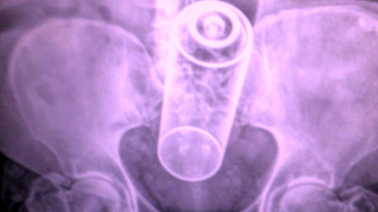 Bizarre: স্বামী কনস্টিপেশনের সমস্যায় অতিষ্ঠ! সিটি স্ক্যানের ছবি দেখে চক্ষু চড়কগাছ স্ত্রী ও চিকিত্‍সকের