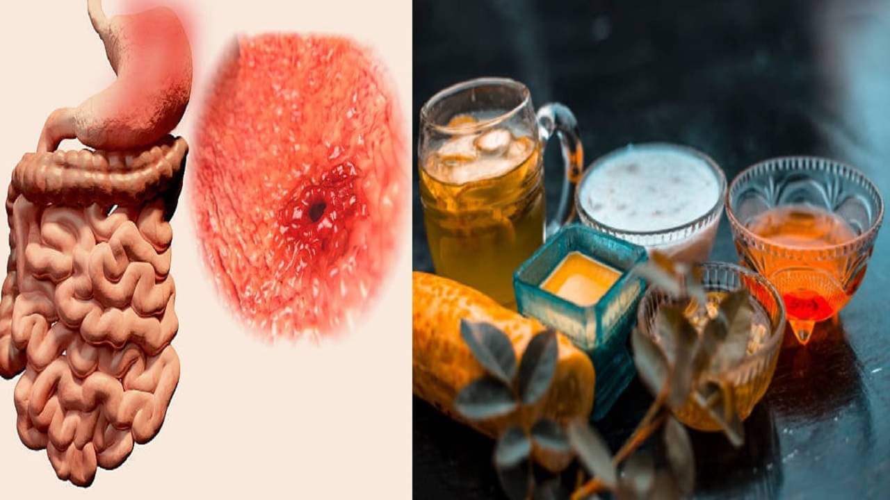 Ulcer: প্রায়শই পেট ব্যথা, খেলেই পেট জ্বালা? যেভাবে বুঝবেন আলসার কি না! রইল কিছু ঘরোয়া প্রতিকারও