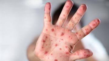 Monkeypox in India: ভারতের মাটিতে মাঙ্কিপক্সে আক্রান্ত বিদেশিনী, দেশে মোট আক্রান্তের সংখ্যা বেড়ে ৯