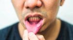 Mouth Ulcer: ওষুধ খেয়েও ঘুরে ফিরে আসছে মুখের আলসার? এই কয়েকটি খাবারেই হবে জব্দ