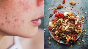 Diet Tips: সঠিক স্কিন কেয়ারেও কাজ হচ্ছে না? ব্রণর সমস্যার জন্য আপনার ডায়েট দায়ী নয় তো! Diet Tips: সঠিক স্কিন কেয়ারেও কাজ হচ্ছে না? ব্রণর সমস্যার জন্য আপনার ডায়েট দায়ী নয় তো!