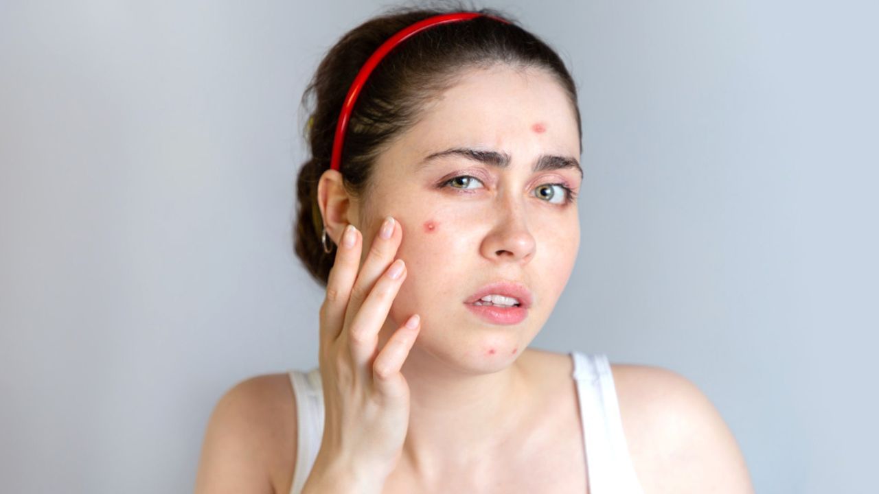 Acne in humid weather: আর্দ্র আবহাওয়ায় ত্বকের দফারফা অবস্থা! বিরক্তিকর ব্রণ থেকে মুক্তি পেতে কী কী করণীয়, জানুন Acne in humid weather: আর্দ্র আবহাওয়ায় ত্বকের দফারফা অবস্থা! বিরক্তিকর ব্রণ থেকে মুক্তি পেতে কী কী করণীয়, জানুন