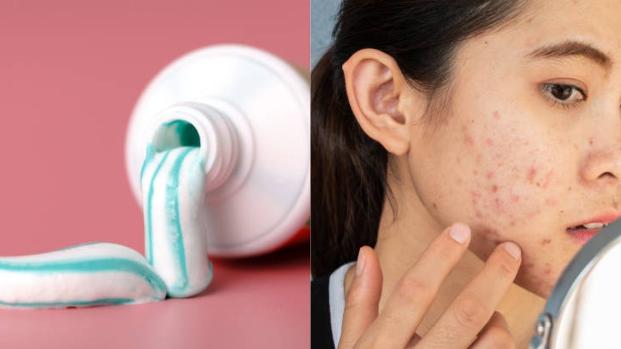 Toothpaste on Pimples ব্রণর উপর টুথপেস্ট লাগাচ্ছেন? ত্বকের মারাত্মক