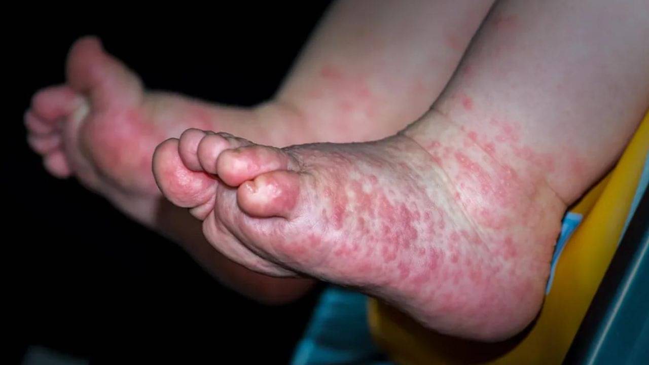 Hand Foot and Mouth Disease: জিভে ফোস্কা, ত্বকে চিকেন পক্সের মত ফুসকুড়ি! নয়া ভাইরাসে কাবু শিশুরা