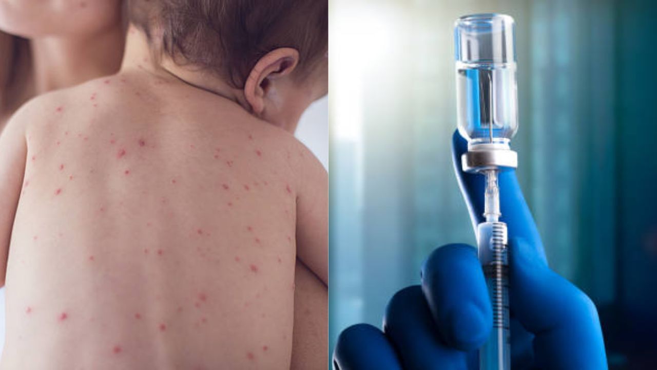 Measles Outbreak: এক দশকের রেকর্ড ভেঙে বাড়ছে হামের প্রকোপ, রোগ এড়াতে কত জরুরি শিশুদের টিকাকরণ?