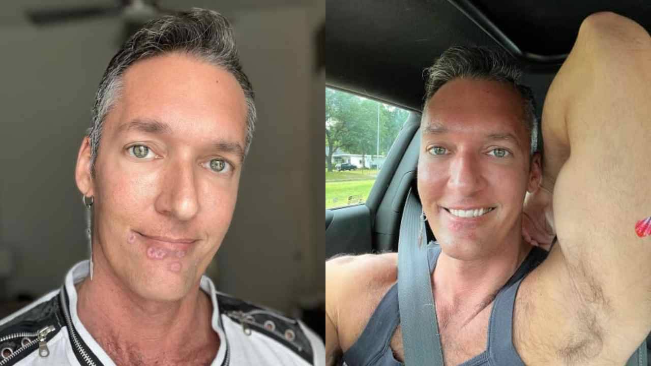 Monkeypox: মাঙ্কিপক্স আক্রান্ত হলে কি চেহারা বদলে যায়? ভাইরাল সমকামী পর্ন অভিনেতার সেলফি কোলাজ