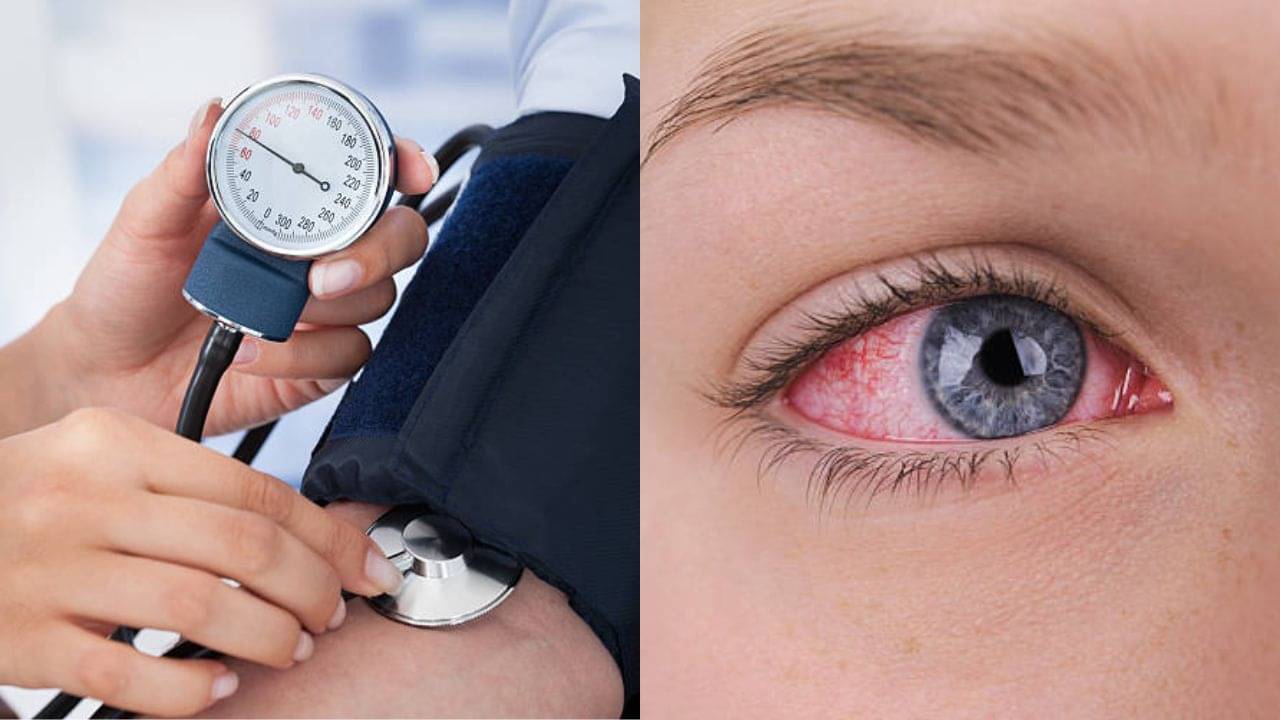 High Blood Pressure: ঘন ঘন চোখ লাল হয়ে যাচ্ছে? শরীরে রক্তচাপের মাত্রা ঠিক আছে তো!