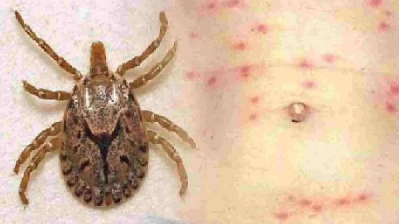 Scrub Typhus: এক সপ্তাহের মধ্যে সিউড়িতে স্ক্রাব টাইফাসে মৃত ২, কী কী উপসর্গ রয়েছে এই রোগের?