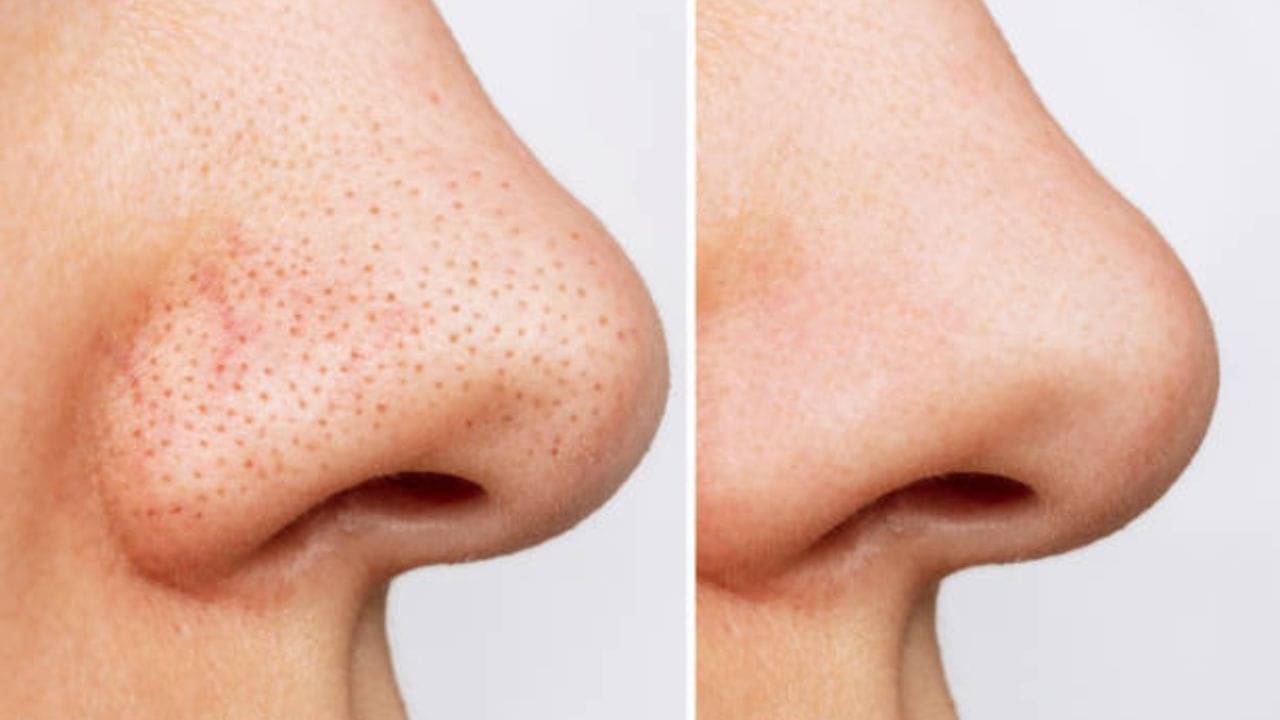 Blackheads: নোজ় স্ট্রিপ বা পিল-অফ মাস্ক নয়, এই প্রাকৃতিক উপাদানেই দূর হবে সব ব্ল্যাকহেডস...