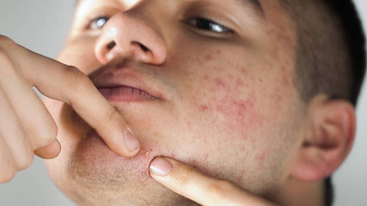 Pimple Problem: ব্রণ নিয়ে এই সব সমস্যার কথা প্রায়ই শোনা যায়, আজ রইল উত্তর...