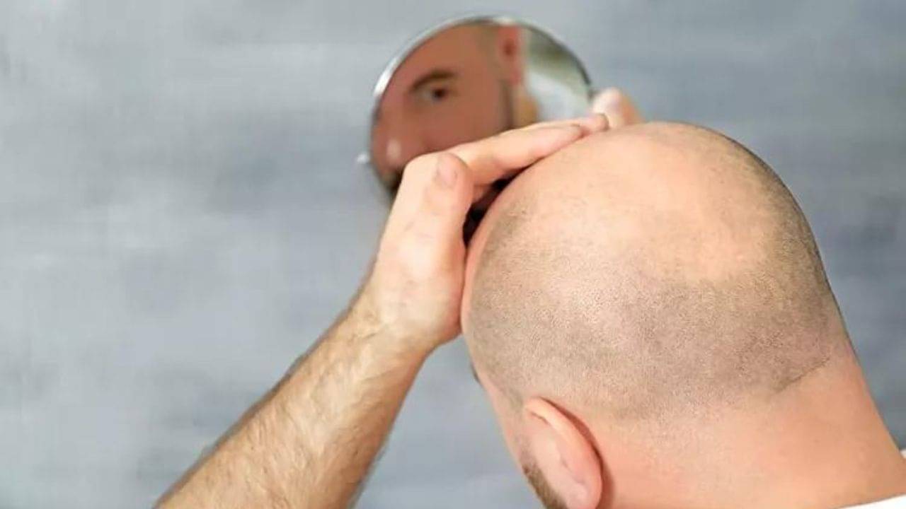 Baldness: টাকে চুল গজাচ্ছে সস্তার পুরনো ওষুধ! স্বল্প ডোজে ওষুধটি খেলে কী কী হতে পারে, অকপট বিশেষজ্ঞরা