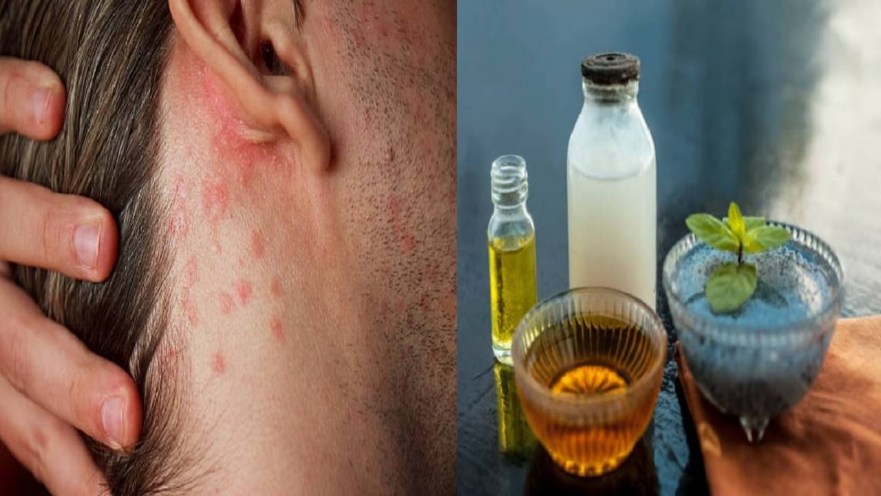 Eczema: একজিমা থেকে সোরিয়াসিস সারবে এই কালোবীজের গুণেই! জানুন কী ভাবে কাজে লাগাবেন