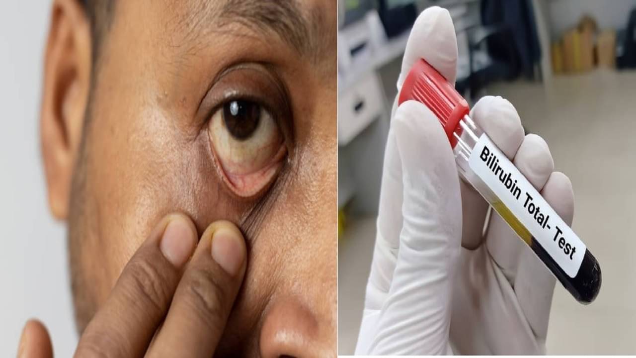 Jaundice: প্রস্রাবে সমস্যা, বমি কিন্তু জন্ডিসেরই লক্ষণ! ঘরোয়া যে সব প্রতিকারে সেরে উঠবেন...