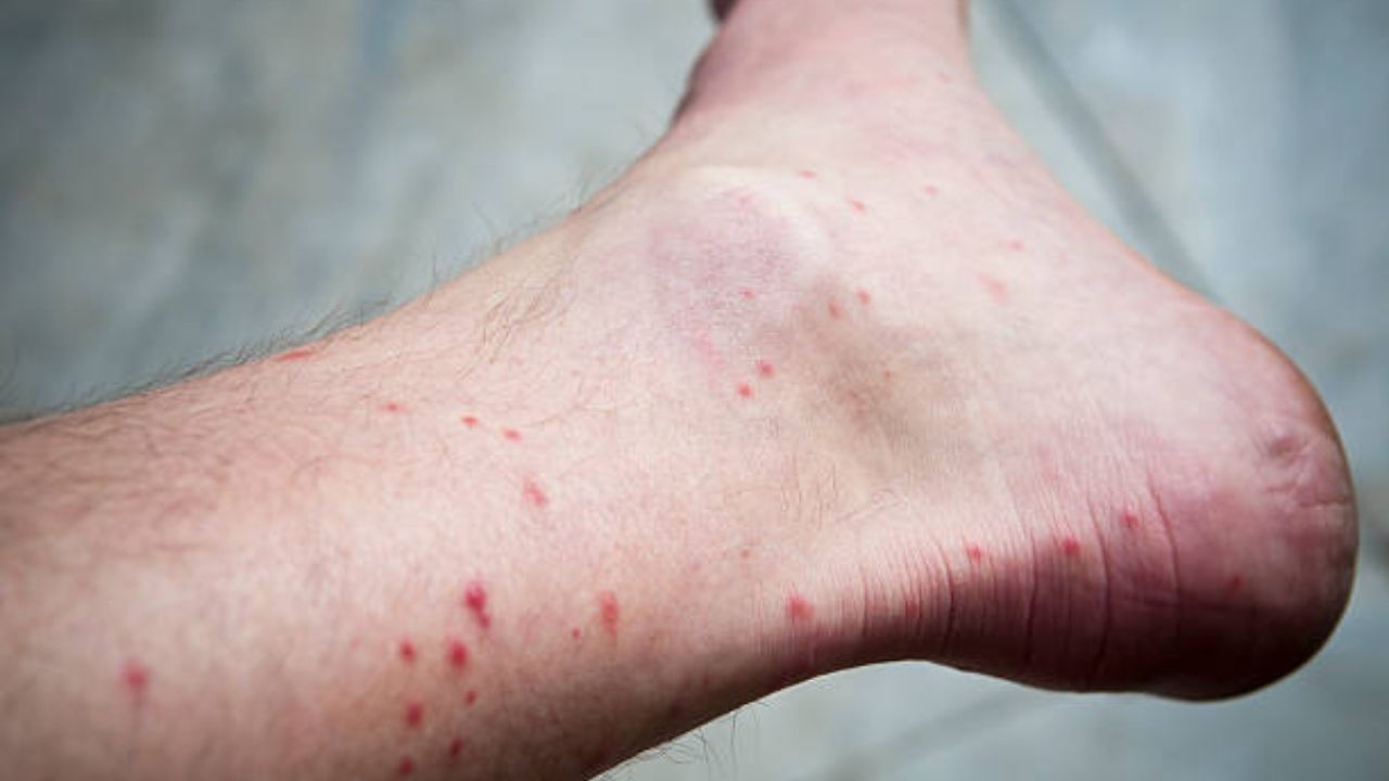 Mosquito Bites: মশা কামড়ালেই ফুলে লাল হয়ে যায়? 