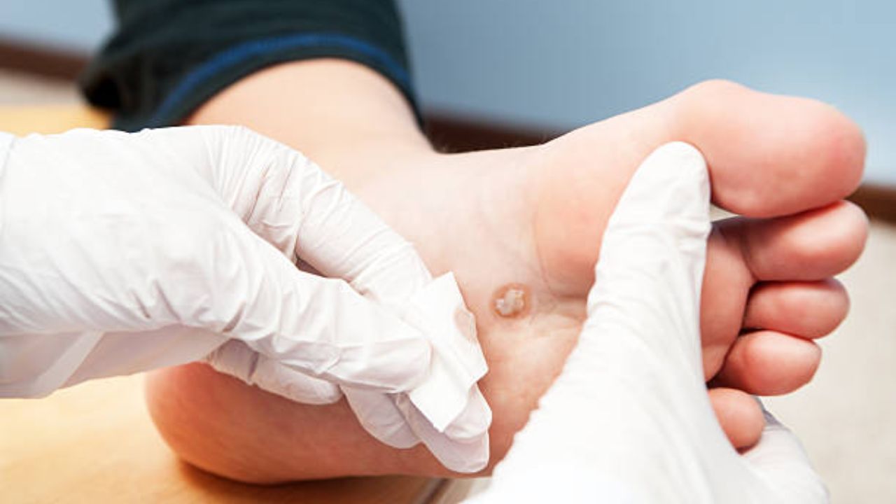 Diabetic Foot Ulcer: দীর্ঘদিন ধরে ডায়াবেটিসে আক্রান্ত? ‘ফুট আলসার’-এর ঝুঁকি এড়াবেন কীভাবে...