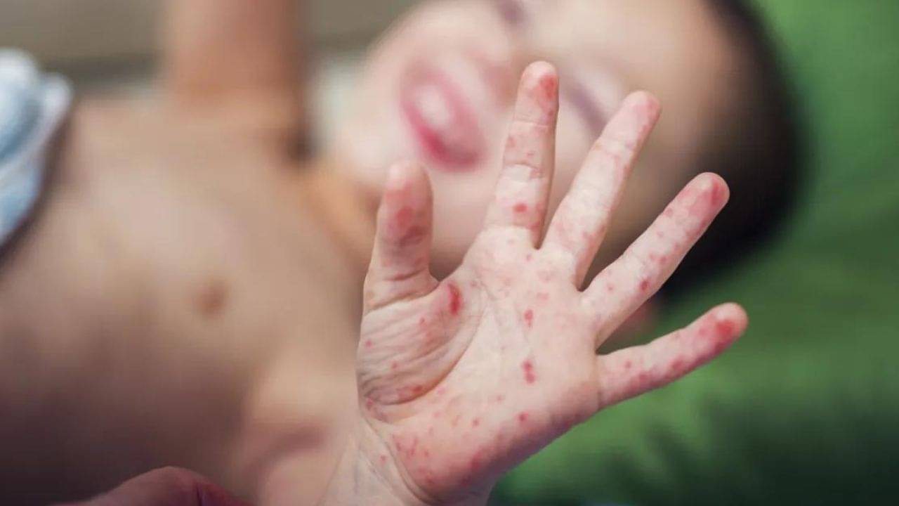 HFMD in Kids: তীব্র জ্বর, মুখে ঘা, গলা ব্যথায় কষ্ট পাচ্ছে আপনার সন্তান? টম্যাটো ফ্লু না সাধারণ ফ্লু ? জেনে নিন কী করবেন, কী করবেন না!