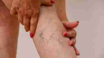 Varicose veins: প্রায়শই পায়ের শিরা ফুলে নীল হয়ে যাচ্ছে, সঙ্গে প্রচণ্ড ব্যথা? মারাত্মক আকার ধারণ করার আগে মেনে চলুন এই ৫ টিপস