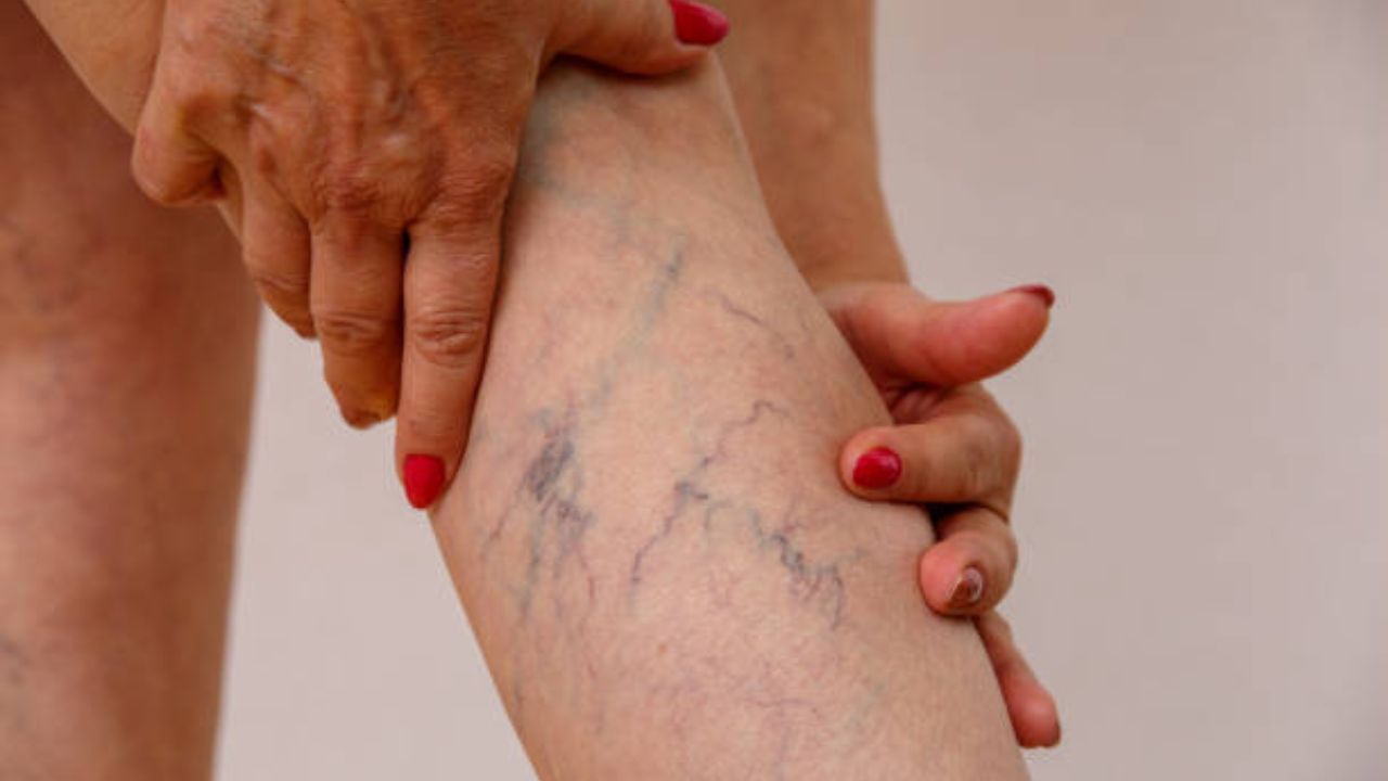 Varicose veins: প্রায়শই পায়ের শিরা ফুলে নীল হয়ে যাচ্ছে, সঙ্গে প্রচণ্ড ব্যথা? মারাত্মক আকার ধারণ করার আগে মেনে চলুন এই ৫ টিপস