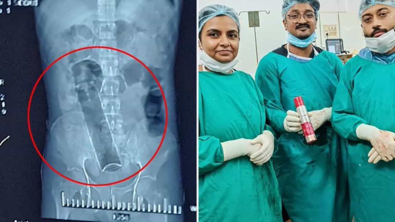 Medical Emergency: পায়ুপথ বন্ধ 'গোপন' কোনও ভুলে? 'ট্যাবু' কাটিয়ে প্রথমেই ছুটে যেতে হবে হাসপাতালে Medical Emergency: পায়ুপথ বন্ধ 'গোপন' কোনও ভুলে? 'ট্যাবু' কাটিয়ে প্রথমেই ছুটে যেতে হবে হাসপাতালে