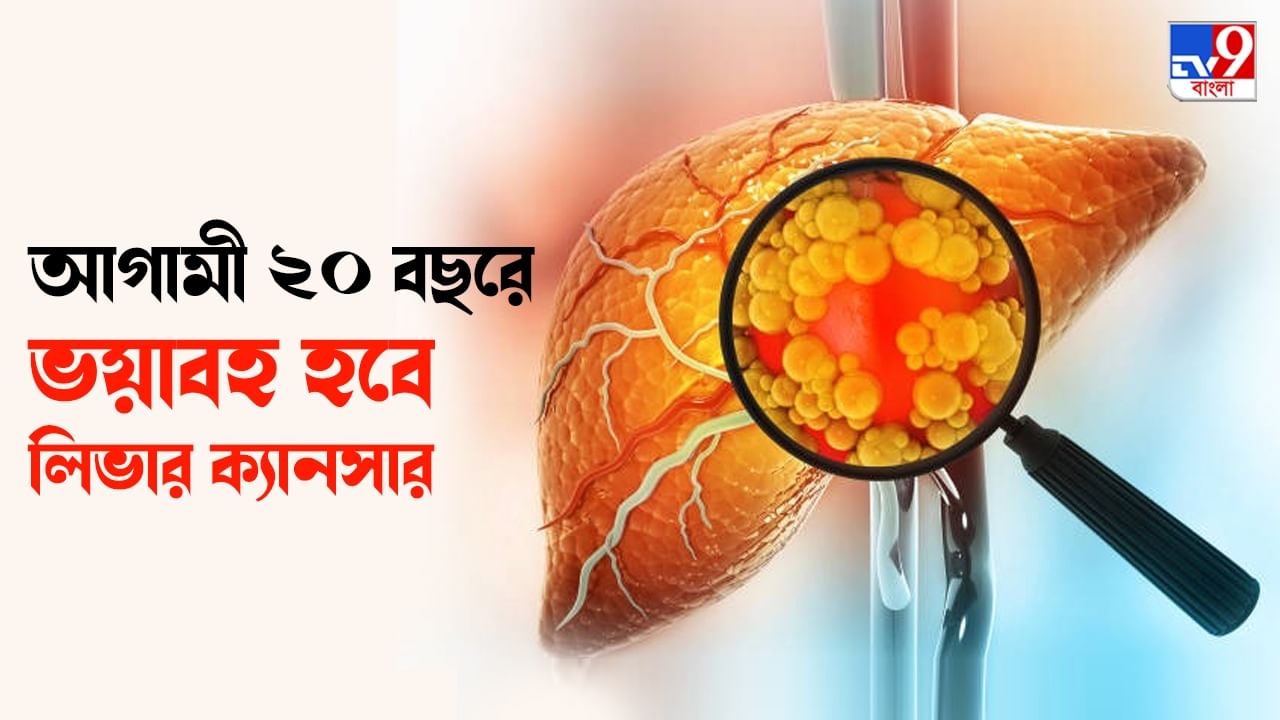 Liver Cancer কর্কটরোগীদের মধ্যে শুধুমাত্র লিভার ক্যানসারেই মৃত্যু হবে