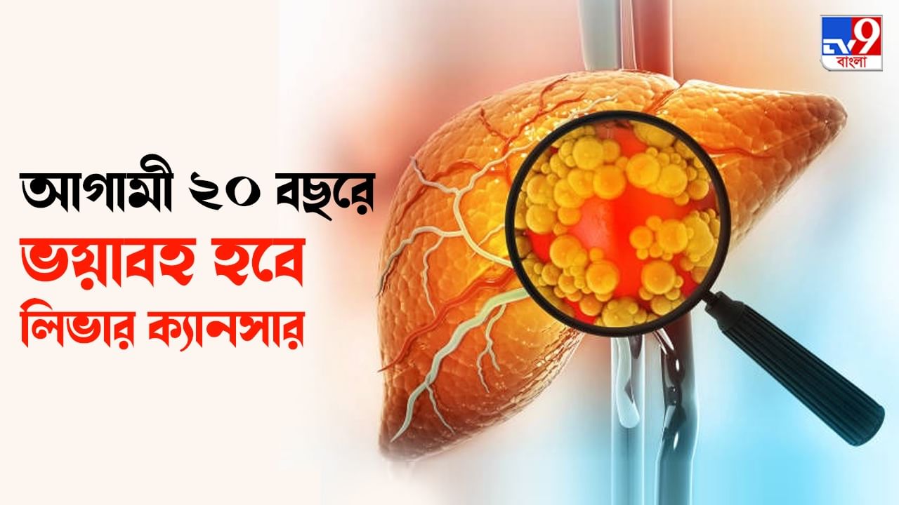Liver Cancer: কর্কটরোগীদের মধ্যে শুধুমাত্র লিভার ক্যানসারেই মৃত্যু হবে ৫৫ শতাংশের: সমীক্ষা Liver Cancer: কর্কটরোগীদের মধ্যে শুধুমাত্র লিভার ক্যানসারেই মৃত্যু হবে ৫৫ শতাংশের: সমীক্ষা