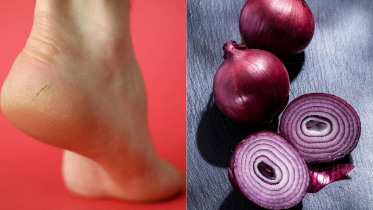 Cracked Heels: ফাটা গোড়ালির যত্নে পেঁয়াজকে কাজে লাগান, পেডিকিওরের খরচ বাঁচাবে