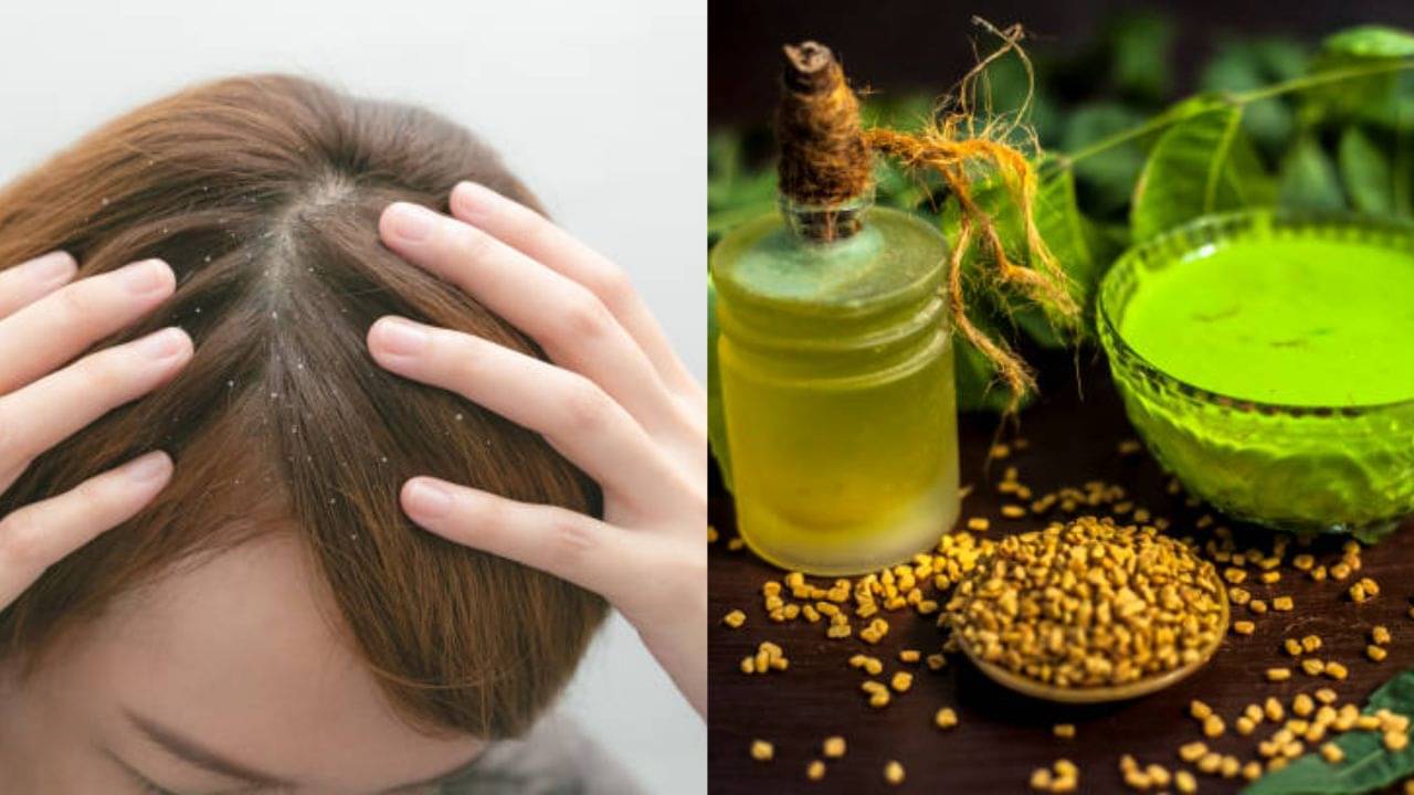 Dandruff: চিরতরে খুশকি থেকে মুক্তি পেতে চান? আয়ুর্বেদের কোন টোটকায় ব্যবহার করবেন, জানুন