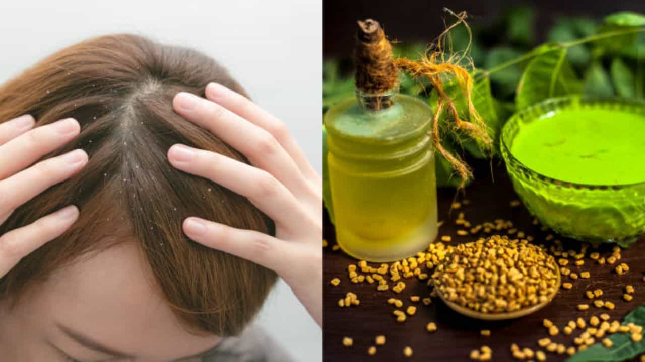 Dandruff: চিরতরে খুশকি থেকে মুক্তি পেতে চান? আয়ুর্বেদের কোন টোটকায় ব্যবহার করবেন, জানুন Dandruff: চিরতরে খুশকি থেকে মুক্তি পেতে চান? আয়ুর্বেদের কোন টোটকায় ব্যবহার করবেন, জানুন