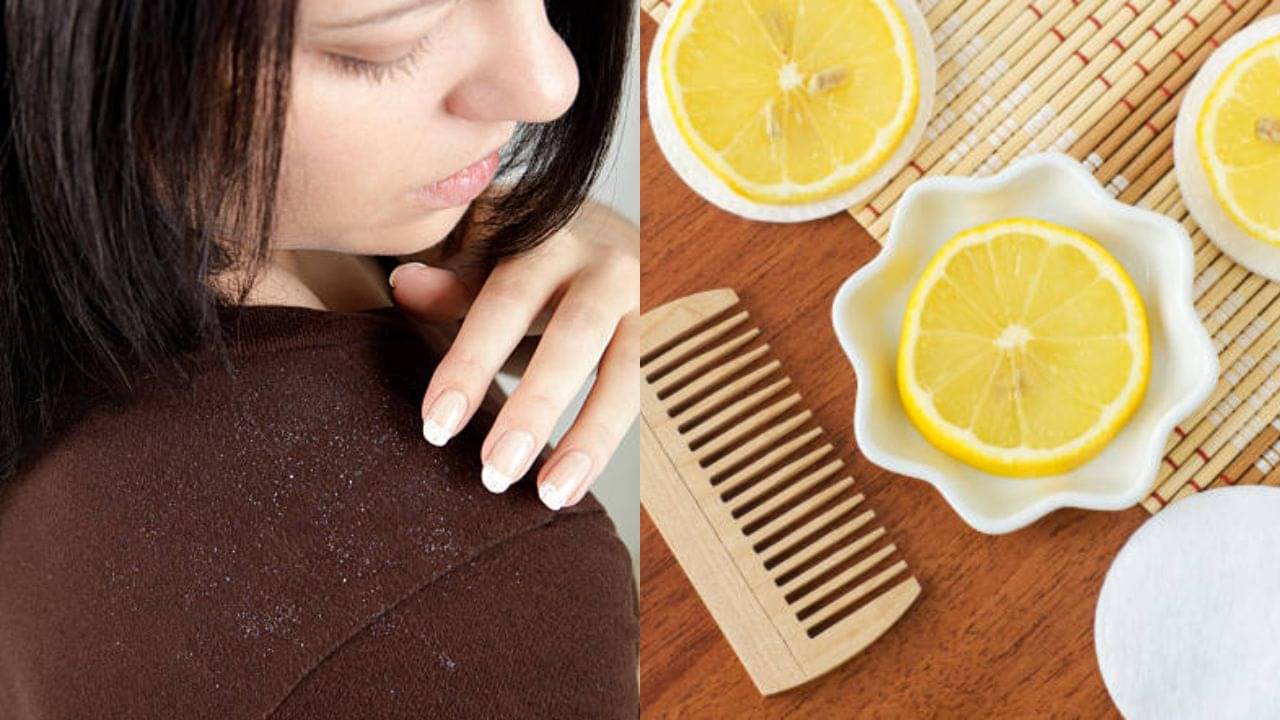 Dandruff: শীতকালে খুশকির উপদ্রব কমিয়ে দেবে পাতিলেবু, কোন উপায়ে ব্যবহার করলে মিলবে সুফল?