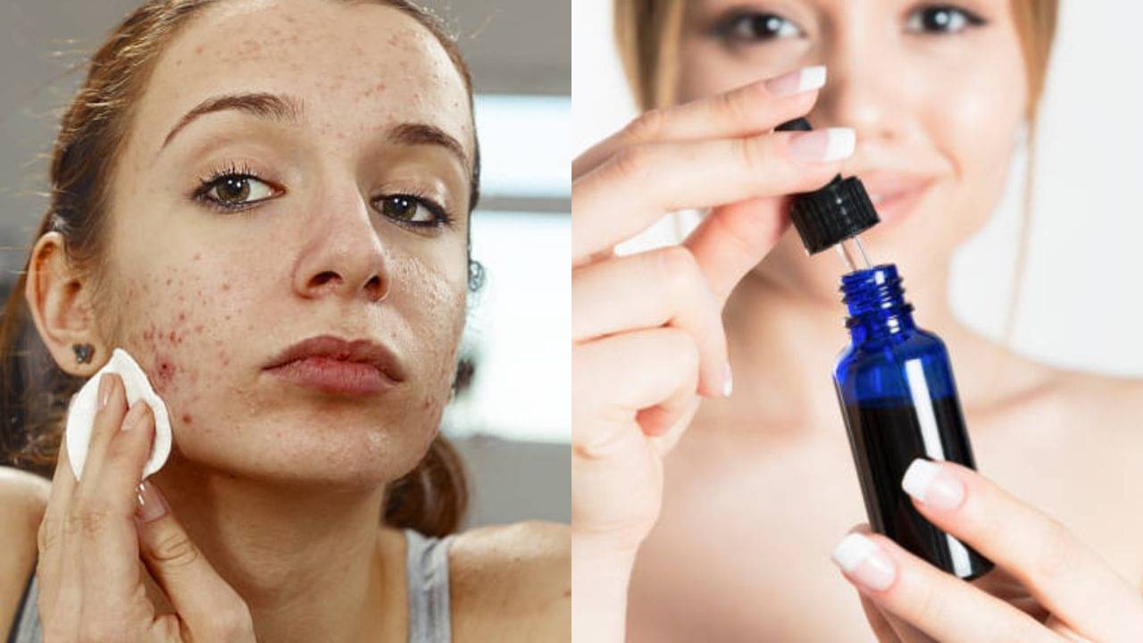 Salicylic Acid: ব্রণ নিয়ে বিরক্ত? দুফোঁটা স্যালিসিলিক অ্যাসিড ব্যবহার করুন এই ভাবে