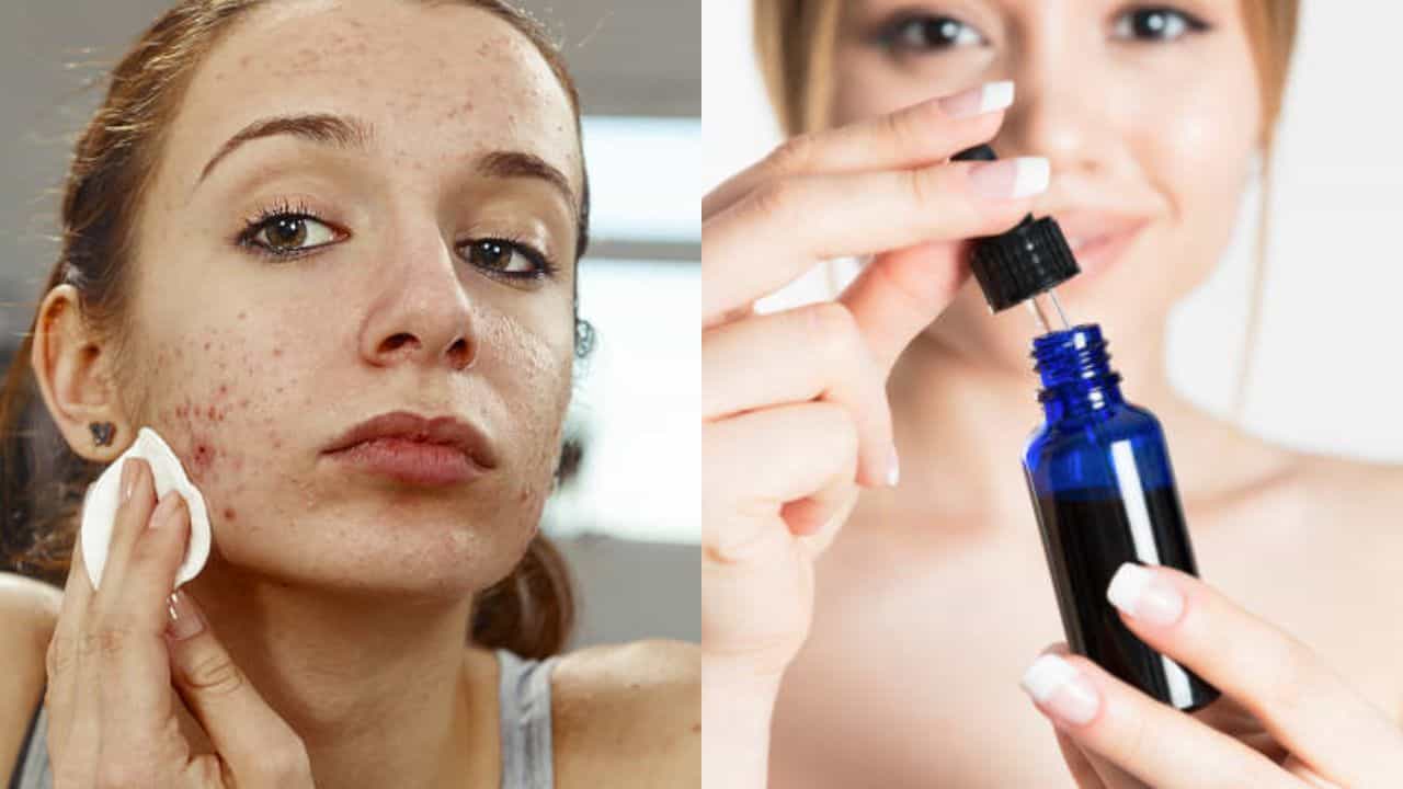 Salicylic Acid: ব্রণ নিয়ে বিরক্ত? দু'ফোঁটা স্যালিসিলিক অ্যাসিড ব্যবহার করুন এই ভাবে