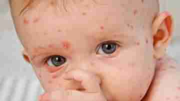 Measles Outbreak:  হু হু করে বাড়ছে হামে আক্রান্ত শিশুর সংখ্যা! মুম্বইয়ে মৃত ১ বছরের শিশু