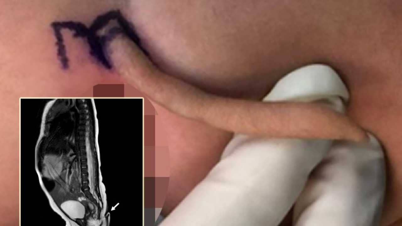 Mexico baby girl tail: নরম, সূক্ষ্ম লোমযুক্ত, ২ ইঞ্চি লম্বা লেজ নিয়ে জন্মাল এই শিশুকন্যা