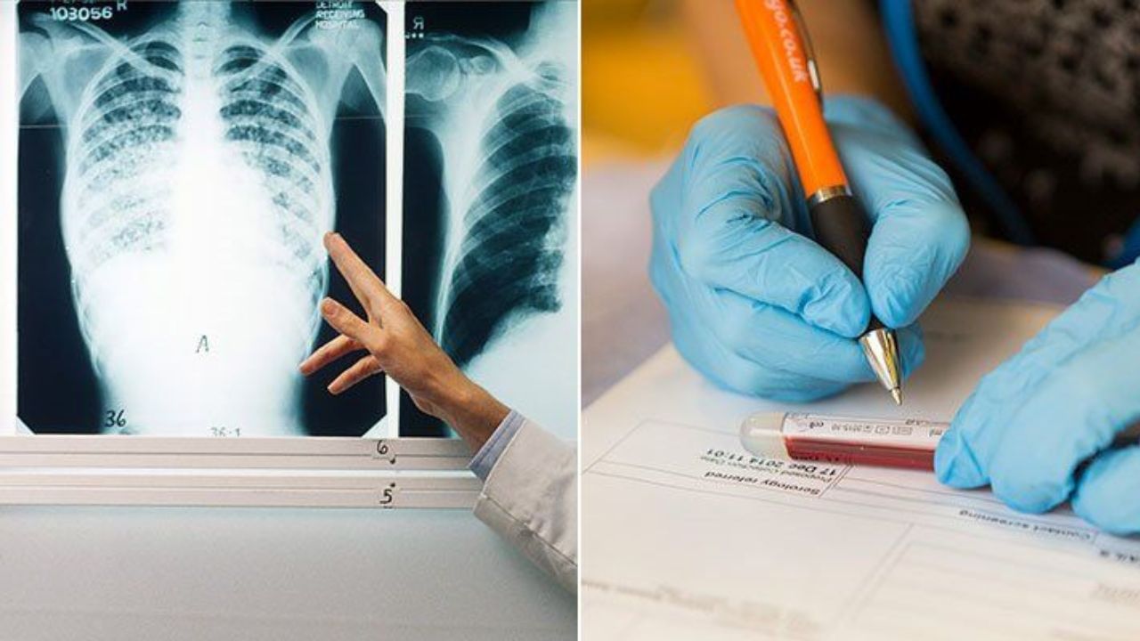 TB Diagnosis কোভিডকালে দেশের ৫ লক্ষেরও বেশি মানুষের যক্ষ্মার চিকিত্