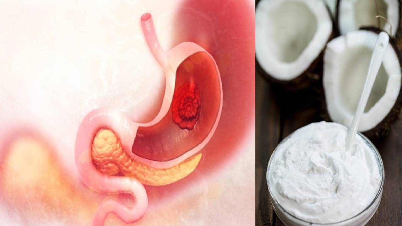 Coconut Cream: শুধু জল নয় ডাবের শাঁসও উপকারী,পাকস্থলীর আলসার-সহ এই ৫টি রোগ থাকবে দূরে...