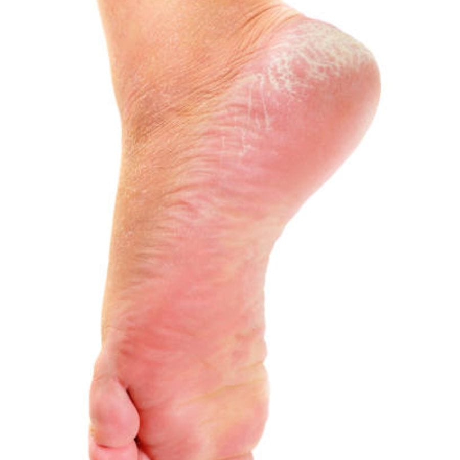 এছাড়াও শীতে চামড়ায় টান ধরে। চামড়া শুকিয়ে যায়। শীতে সবচাইতে বেশি যে সমস্যা হয় তা হল গোড়ালি ফেটে যাওয়া (Cracked Heels)। পা ফাটলে দেখতে যেমন বাজে লাগে তেমনই থাকে সংক্রমণের সম্ভাবনা। ফাটা গোড়ালি নিয়ে জনসমক্ষে বেরনোও সমস্যা।