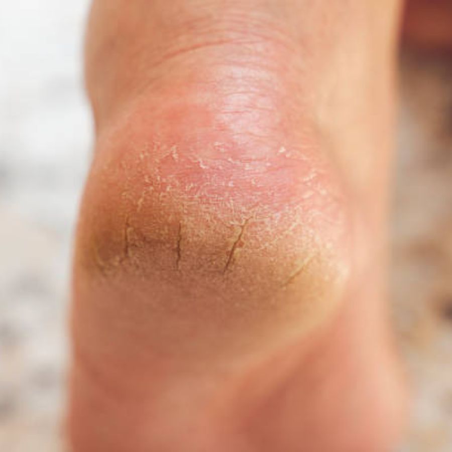 পায়ের গোড়ালি ফাটার (Cracked Heels) পিছনে অনেক কারণ রয়েছে বটে। ধুলাবালিতে বেশি কাজ করা, মৃত কোষ না সরানো, পা পরিষ্কার না রাখা, ঠাণ্ডা আবহাওয়ায় ক্রিম না লাগার কারণে শুষ্ক হয়ে যাওয়া ইত্যাদি কারণগুলি এই তালিকায় রয়েছে।