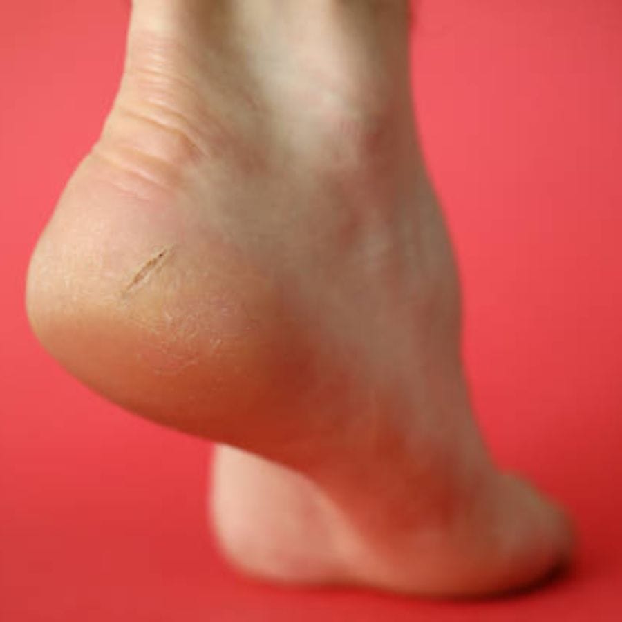 এই গোড়ালি ফাটার পিছনে একাধিক কারণ রয়েছে। ধুলোতে পায়ে বেশি ময়লা বসে। শীতে দূষণ আর ধুলো দুই বাড়ে। এবার নিয়মমতো পা পরিষ্কার না হলে তাতে ময়লা জমবেই। সম্প্রতি আয়ুর্বেদ চিকিৎসক অলকা বিজয়ন তাঁর ইনস্টাগ্রামে একটি পোস্ট শেয়ার করে ফাটা পায়ের সঙ্গে পেটের সমস্যার সম্পর্ক ব্যখ্যা করেছেন।