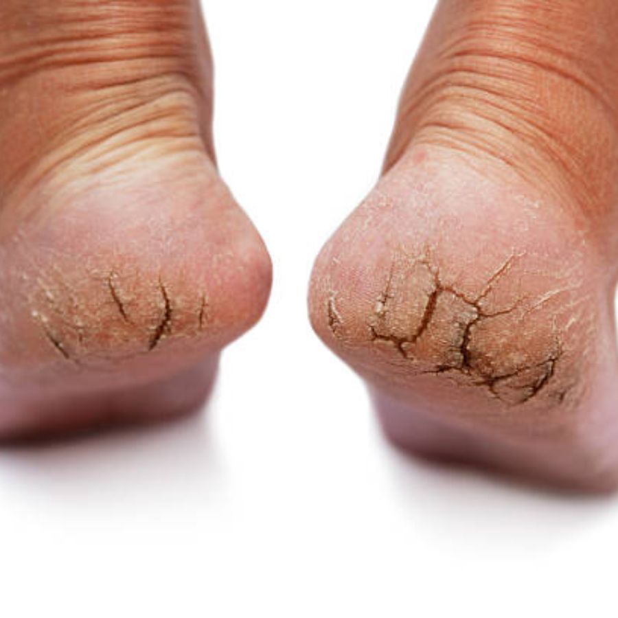 পা ফাটার সমস্যা বেশি হলেই ধরে নেওয়া হয় যে সেই ব্যক্তিটি পেটের কোনও সমস্যায় ভুগছেন। হজম ঠিকমতো না হলে, মুখে ব্রণর সমস্যা হলে, প্রায়শই জিভে আলসার হলে, অ্যাসিডিটির কারণেও পা ফাটতে পারে।