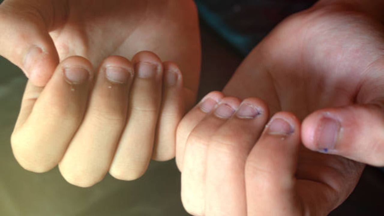 Nail biting দাঁত দিয়ে নখ কাটেন? তাহলে আপনিও এই মারাত্মক রোগে আক্রান্ত