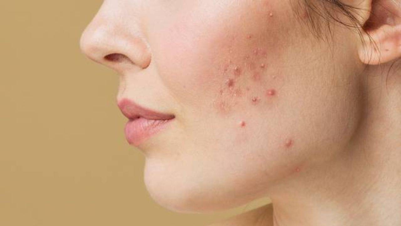 Acne Scars: ব্রণর কালো জেদি দাগের সমস্যায় বিরক্ত! মুক্তি পান মাত্র ৩ ঘরোয়া ও খুব সহজ উপায়ে