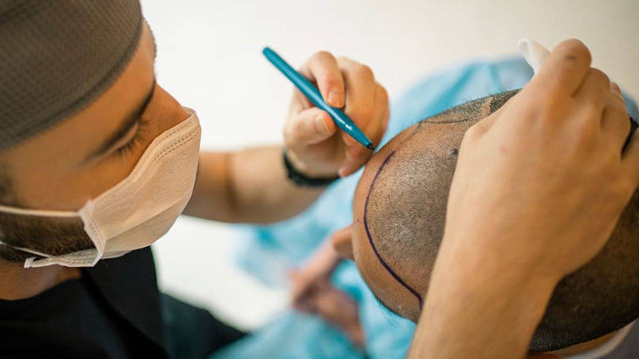 Hair Transplant: হেয়ার ট্রান্সপ্লান্ট করতে গিয়ে মৃত্যু ৩০ বছরের যুবকের! কতখানি ঝুঁকির?